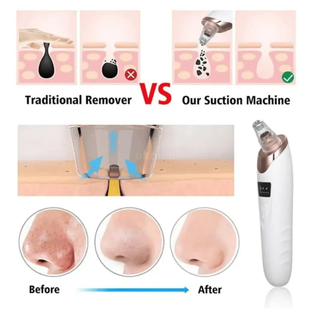 Electric Pore Vacuum Blackhead Remover Skin Care